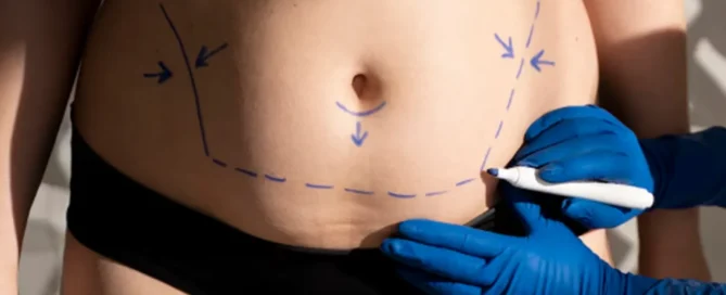 Primer plano del torso y muslos de una paciente con ropa interior negra. Una mano con guante azul marca líneas quirúrgicas con un rotulador en el abdomen.